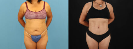 Tummy Tuck case #7458