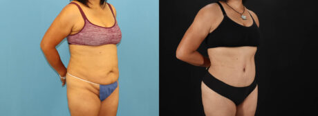 Tummy Tuck case #7458