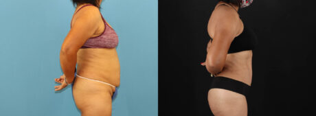Tummy Tuck case #7458