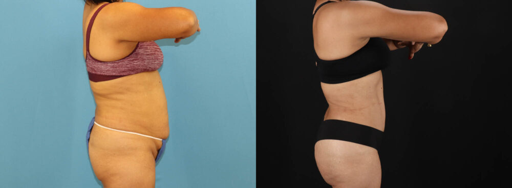 Tummy Tuck case #7458