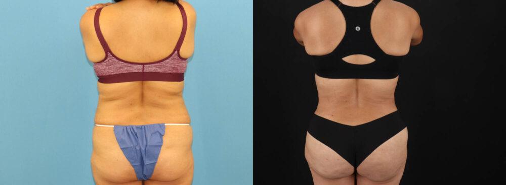 Tummy Tuck case #7458