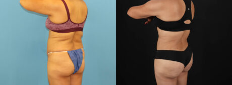 Tummy Tuck case #7458