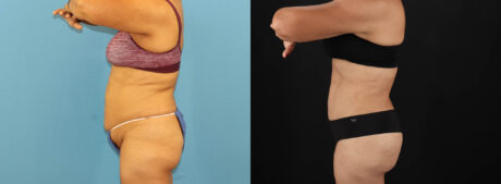 Tummy Tuck case #7458