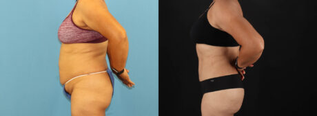 Tummy Tuck case #7458