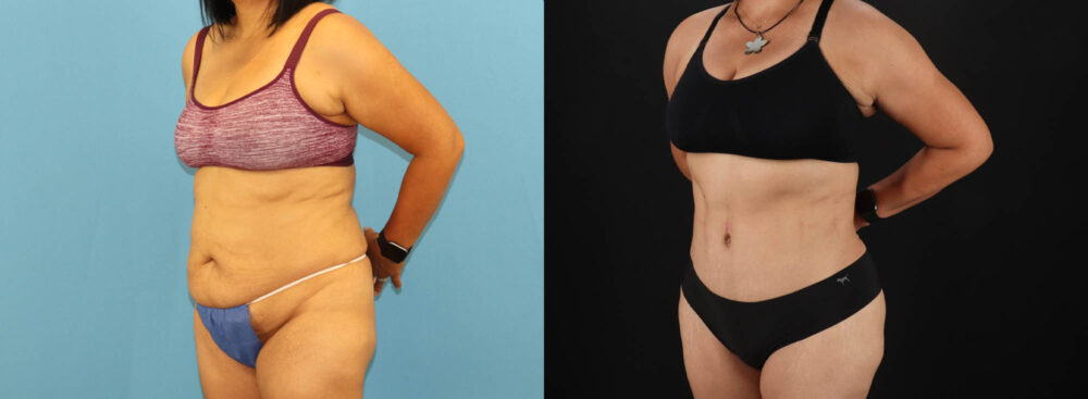 Tummy Tuck case #7458