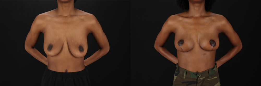 Breast Lift case #7806