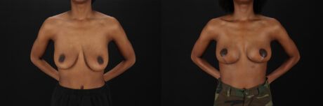 Breast Lift case #7806