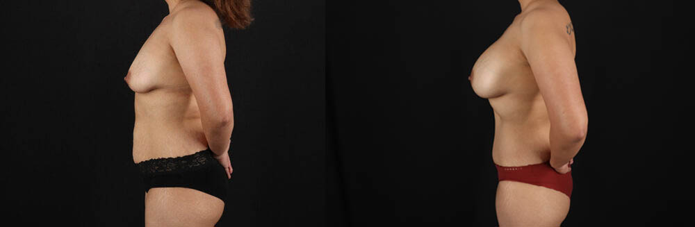 Mommy Makeover case #6687