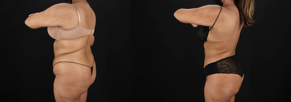 Brazilian Butt Lift case #5394