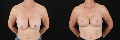 Revision Breast Surgery case #256267