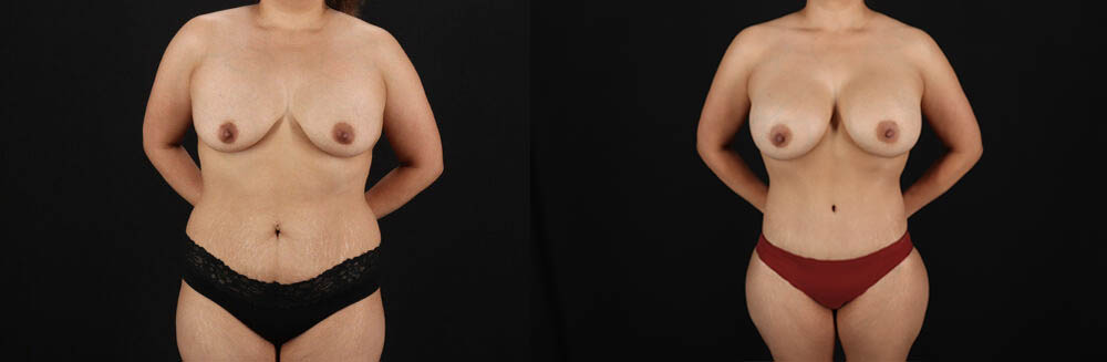 Mommy Makeover case #6687