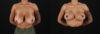 Breast Reduction case #8025 slider thumbnail
