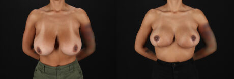 Breast Reduction case #8025