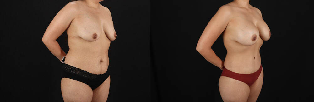 Mommy Makeover case #6687