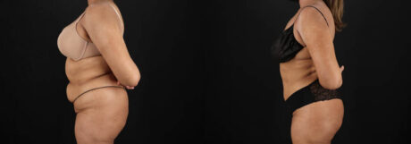 Brazilian Butt Lift case #5394