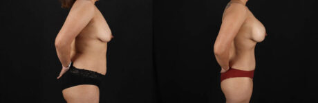 Mommy Makeover case #6687