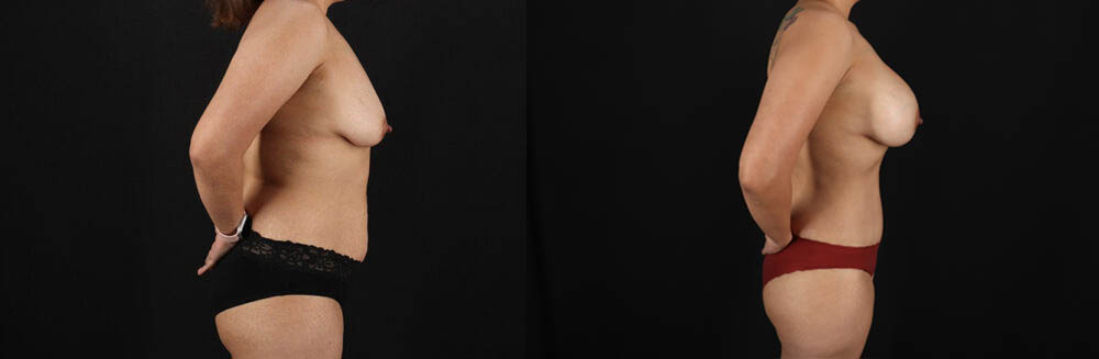 Mommy Makeover case #6687