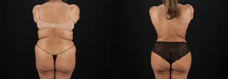 Brazilian Butt Lift case #5394