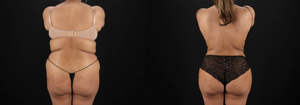 Brazilian Butt Lift case #5394