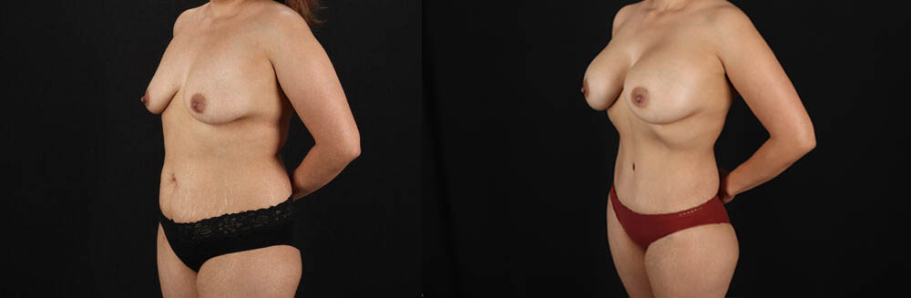 Mommy Makeover case #6687