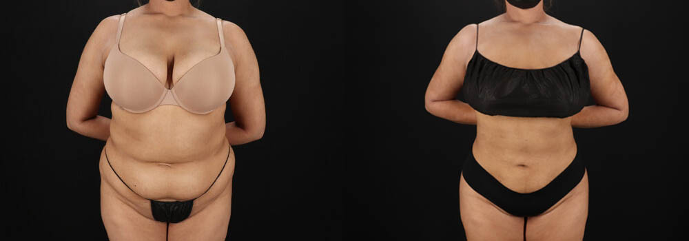 Brazilian Butt Lift case #5394