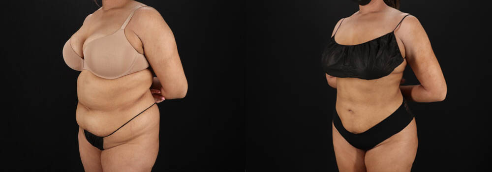 Brazilian Butt Lift case #5394