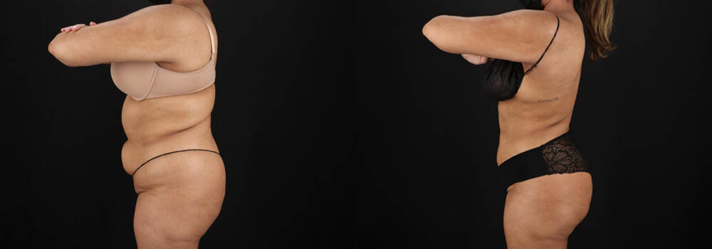 Brazilian Butt Lift case #5394