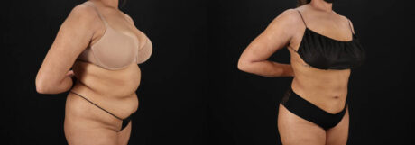 Brazilian Butt Lift case #5394