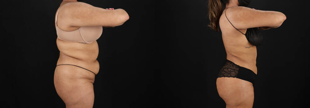 Brazilian Butt Lift case #5394