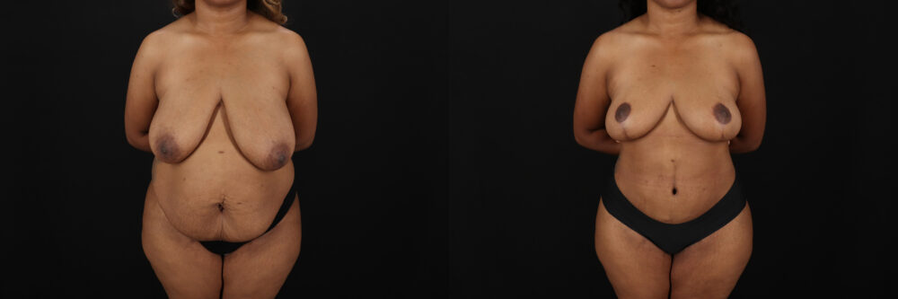 Post Bariatric Surgery (Massive Weight Loss) case #6782