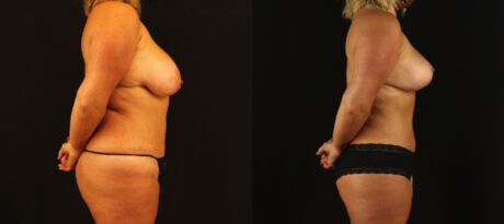 Mommy Makeover case #6515