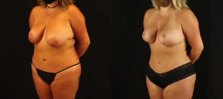 Mommy Makeover case #6515