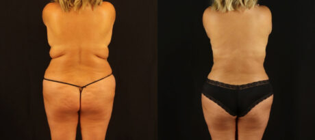 Mommy Makeover case #6515