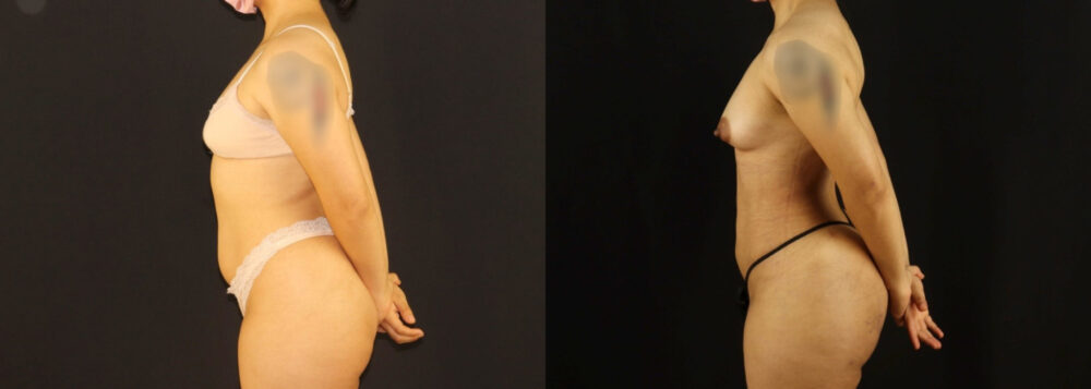 Brazilian Butt Lift case #5170