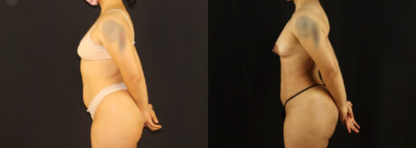 Brazilian Butt Lift case #5170