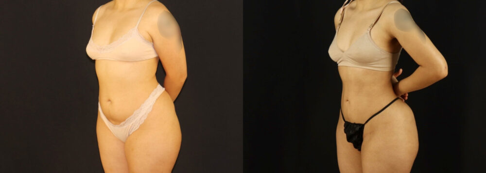 Brazilian Butt Lift case #5170