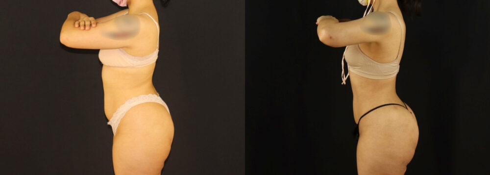 Brazilian Butt Lift case #5170