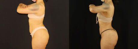 Brazilian Butt Lift case #5170