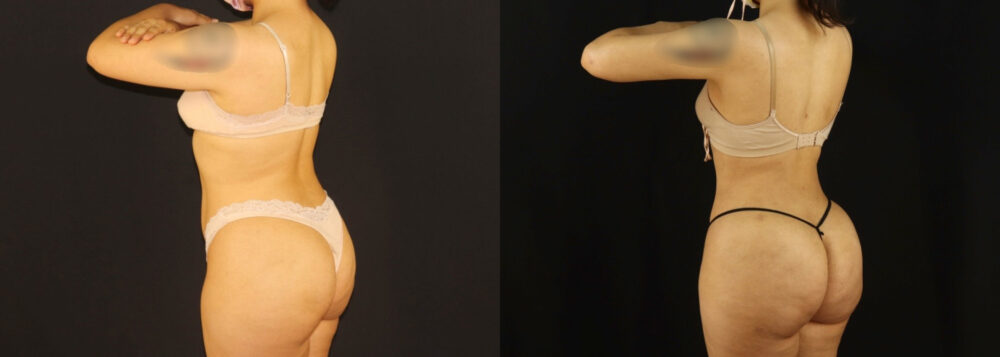 Brazilian Butt Lift case #5170