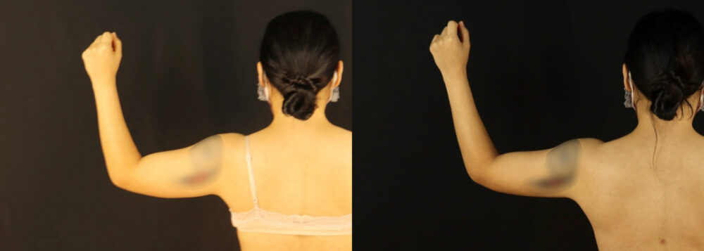 Brazilian Butt Lift case #5170