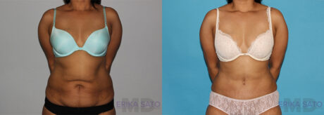 Tummy Tuck case #7227