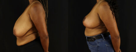 Breast Reduction case #7969