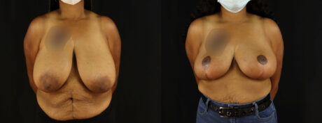 Breast Reduction case #7969