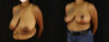 Breast Reduction case #7969 slider thumbnail