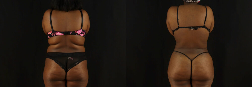 Brazilian Butt Lift case #5171