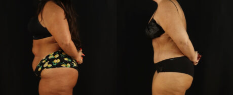 Tummy Tuck case #7350