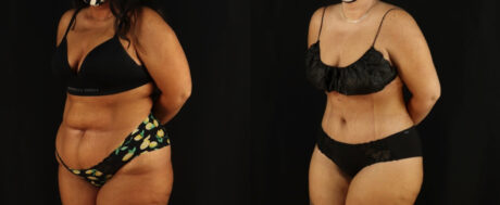 Tummy Tuck case #7350