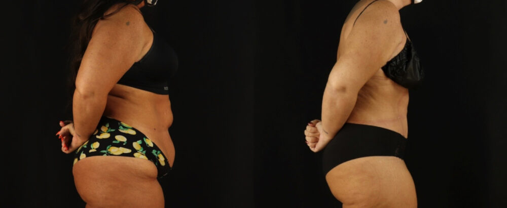 Tummy Tuck case #7350