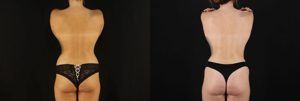 Mommy Makeover case #6516