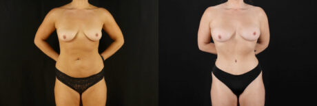 Mommy Makeover case #6516